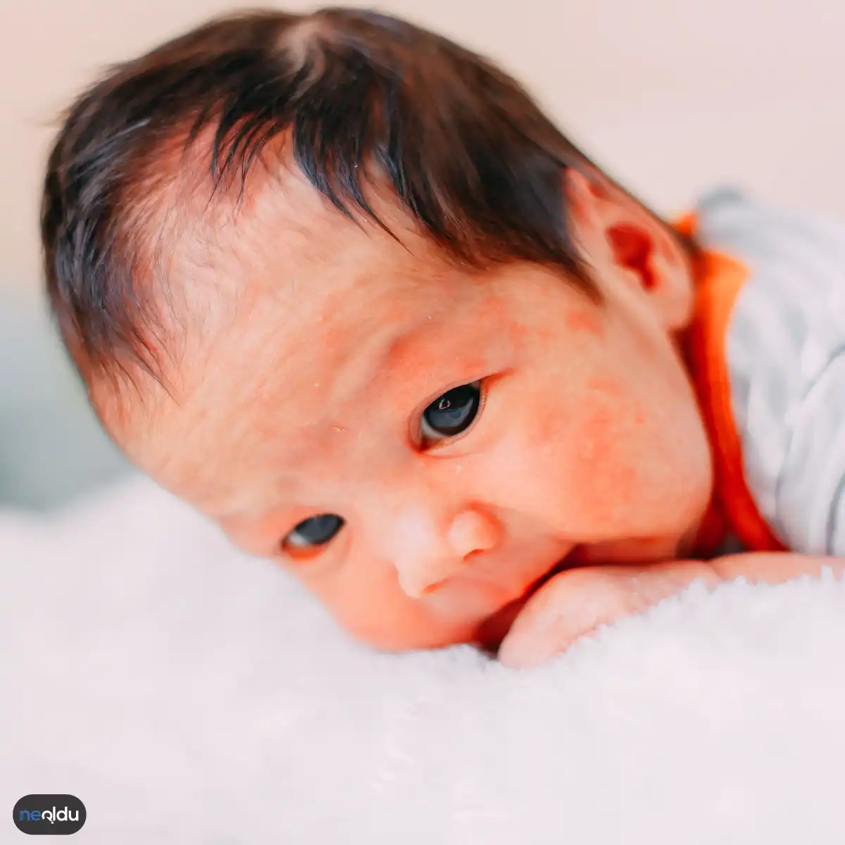 Bebeklerde Görülen Muz Alerjisi Neden Olur?