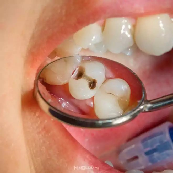 Sağlıklı Dişler İçin Yapılması Gerekenler 