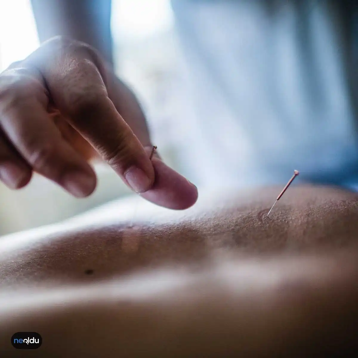 Akupunktur Nedir?