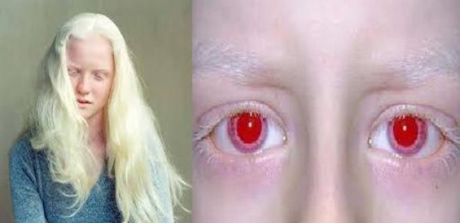 albinizm-hakkinda-bilinmesi-gerekenler-006.jpg