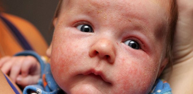 Bebeklerde alerji