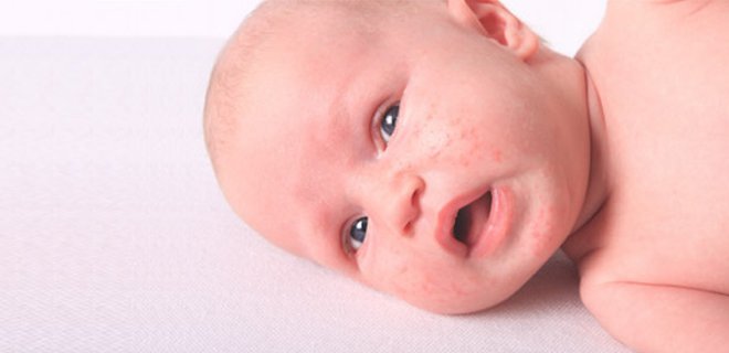 bebeklerde-alerji.jpg