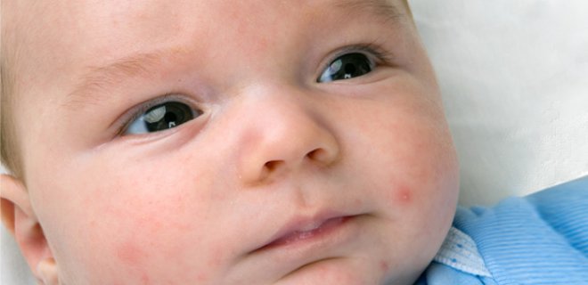 bebeklerde-cevresel-alerji.jpg