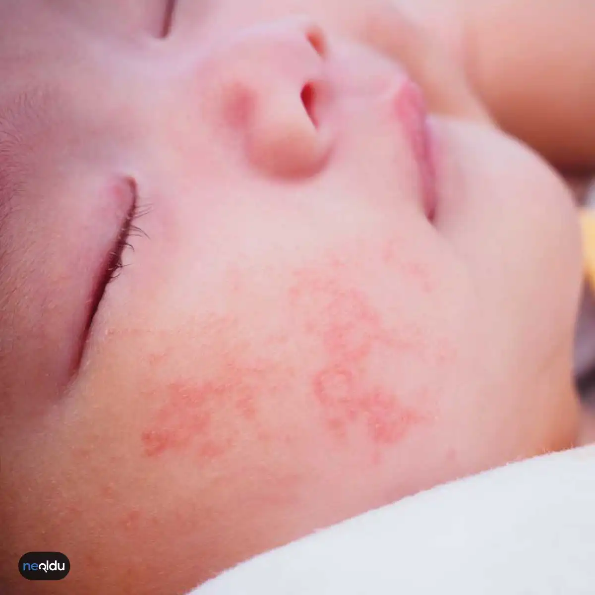 Bebeklerde Görülen Alerjiler