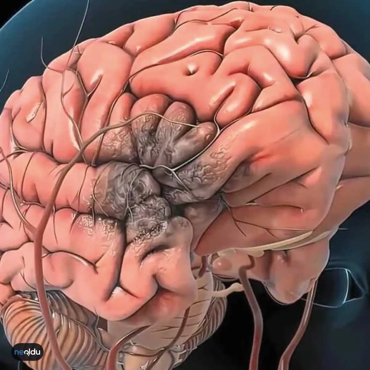 Beyin Kanaması Nedir, Belirtileri ve Tedavisi Nasıldır?