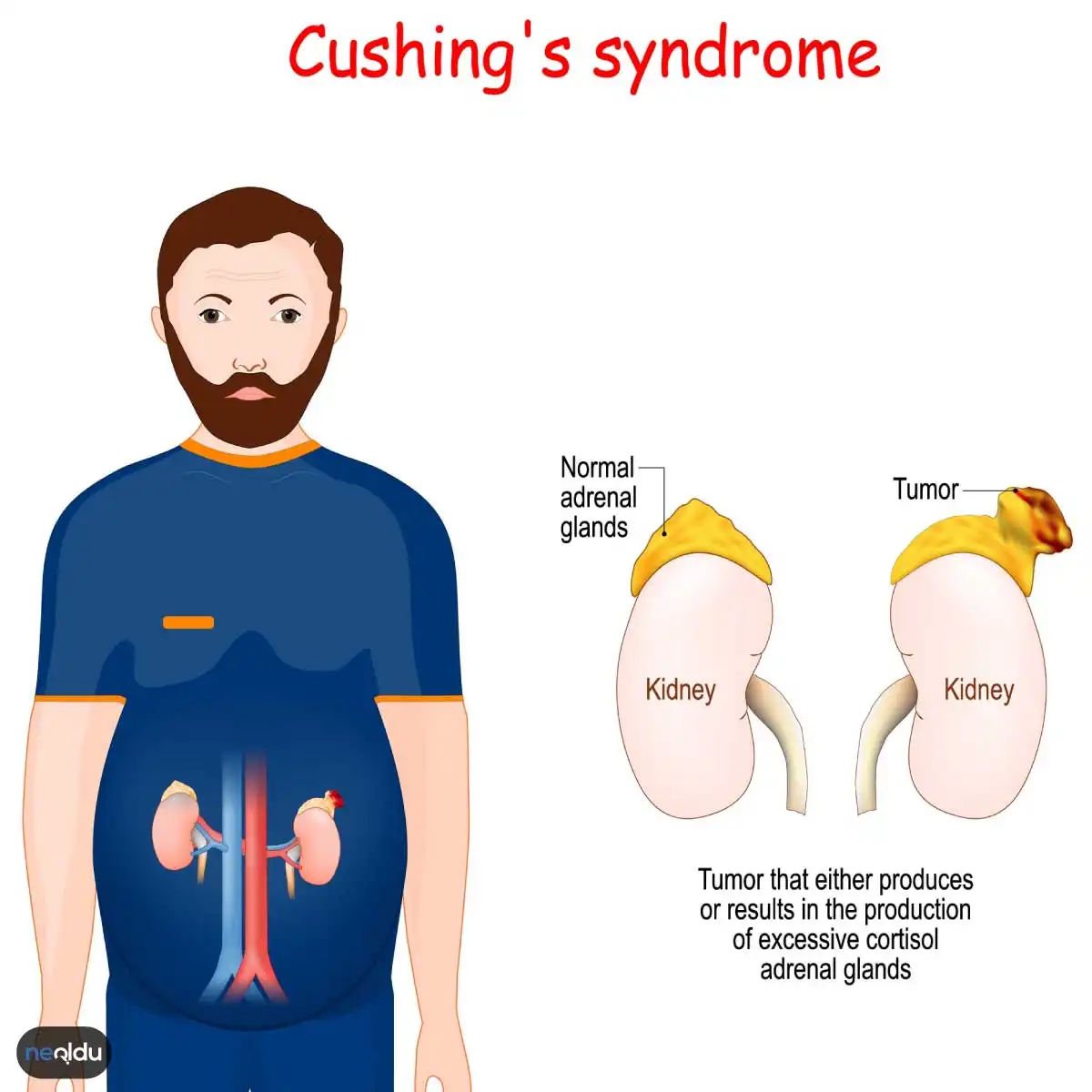 Cushing Hastalığı