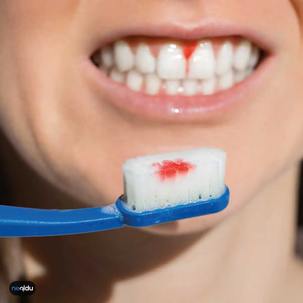 Diş Eti Hastalığı Nedir, Neden Olur? Belirtileri ve Tedavisi