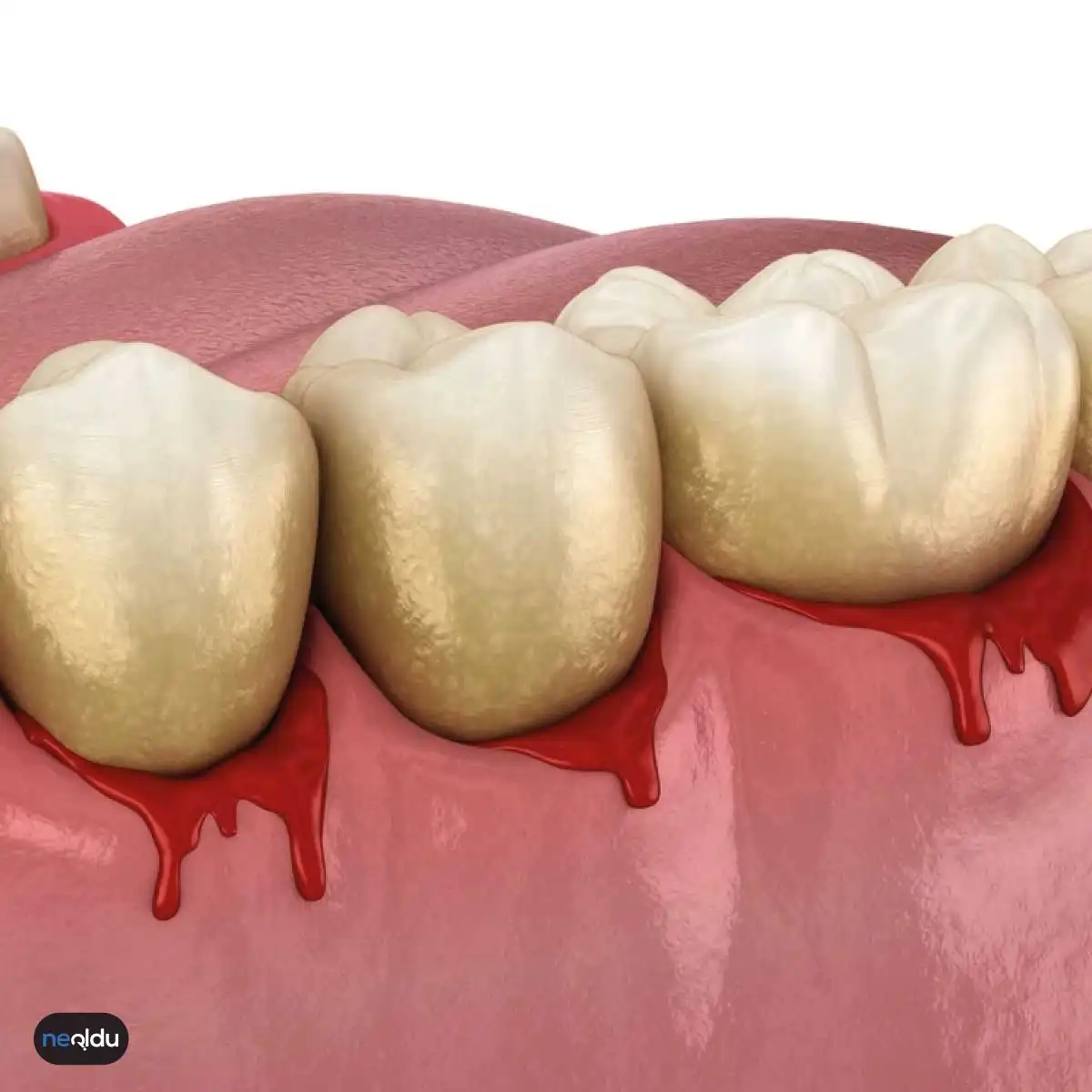Diş Eti Kanaması Neden Olur? Belirtileri ve Doğal Çözümleri