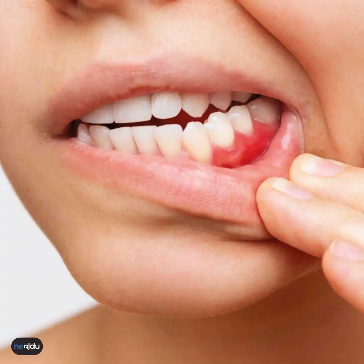 Diş Eti Kanaması Neden Olur? Belirtileri ve Doğal Çözümleri