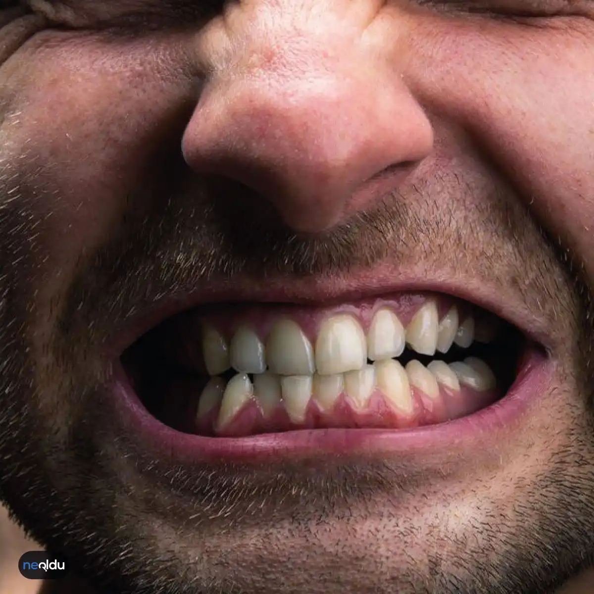Diş Gıcırdatma Nedir, Kimlerde Olur? Nedenleri ve Tedavisi