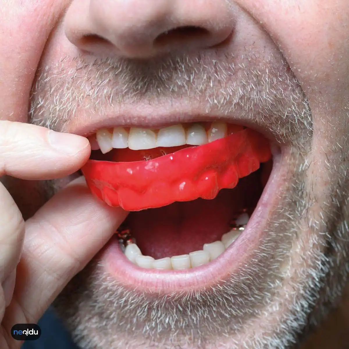 Diş Gıcırdatma Nedir, Kimlerde Olur? Nedenleri ve Tedavisi