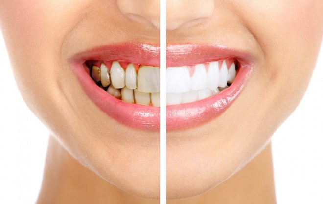 Diş Bakımı ve Diş Temizliği Nasıl Yapılmalı?