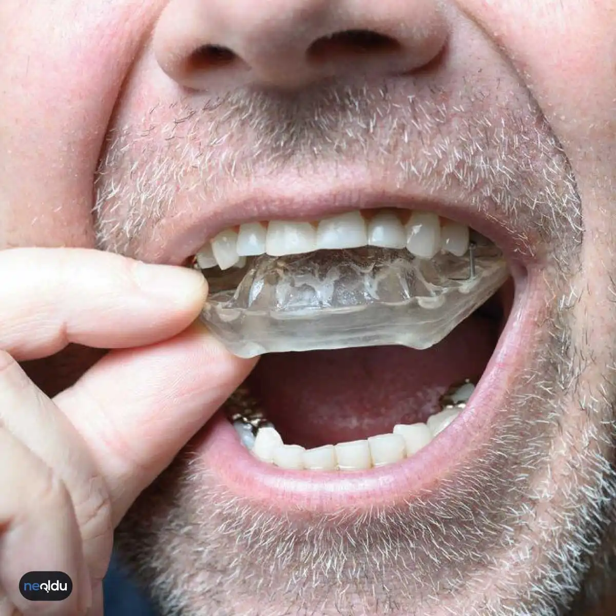 Diş Sıkma Neden Olur, Nasıl Tedavi Edilir?