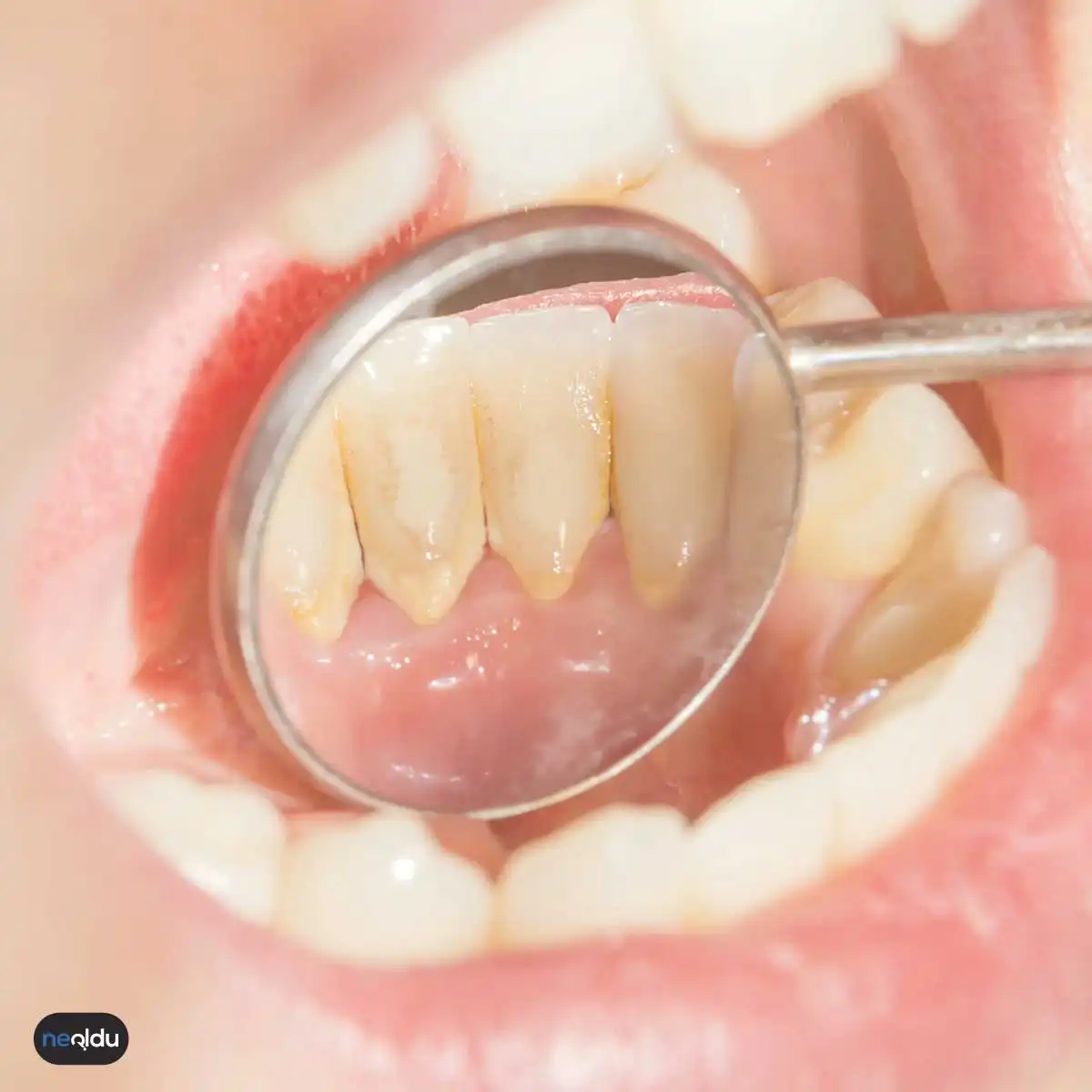 Diş Taşı-Tartar Nedir, Nasıl Temizlenir?