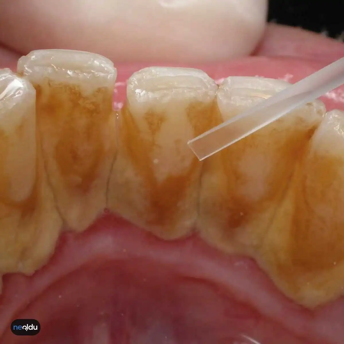 Diş Taşı-Tartar Nedir, Nasıl Temizlenir?