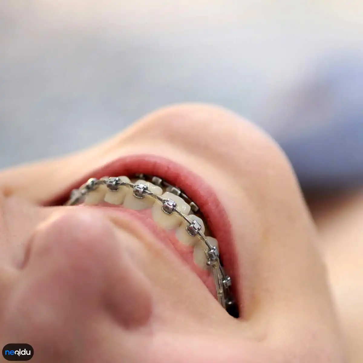 Diş Teli Bakımı ve Temizliği Nasıl Yapılır?