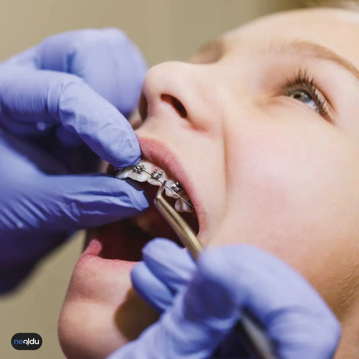 Diş Teli Nedir, Nasıl Takılır, Takılmadan Önce Ne Yapılır?
