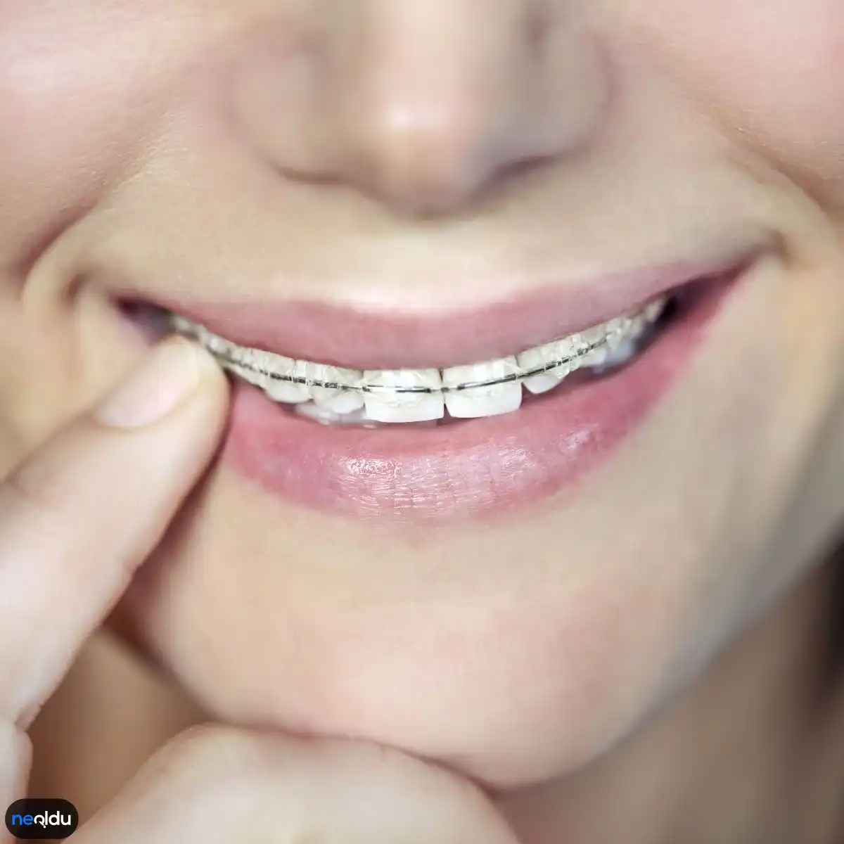 Diş Teli Takacak Kişilerin Mutlaka Bilmesi Gereken Bilgiler