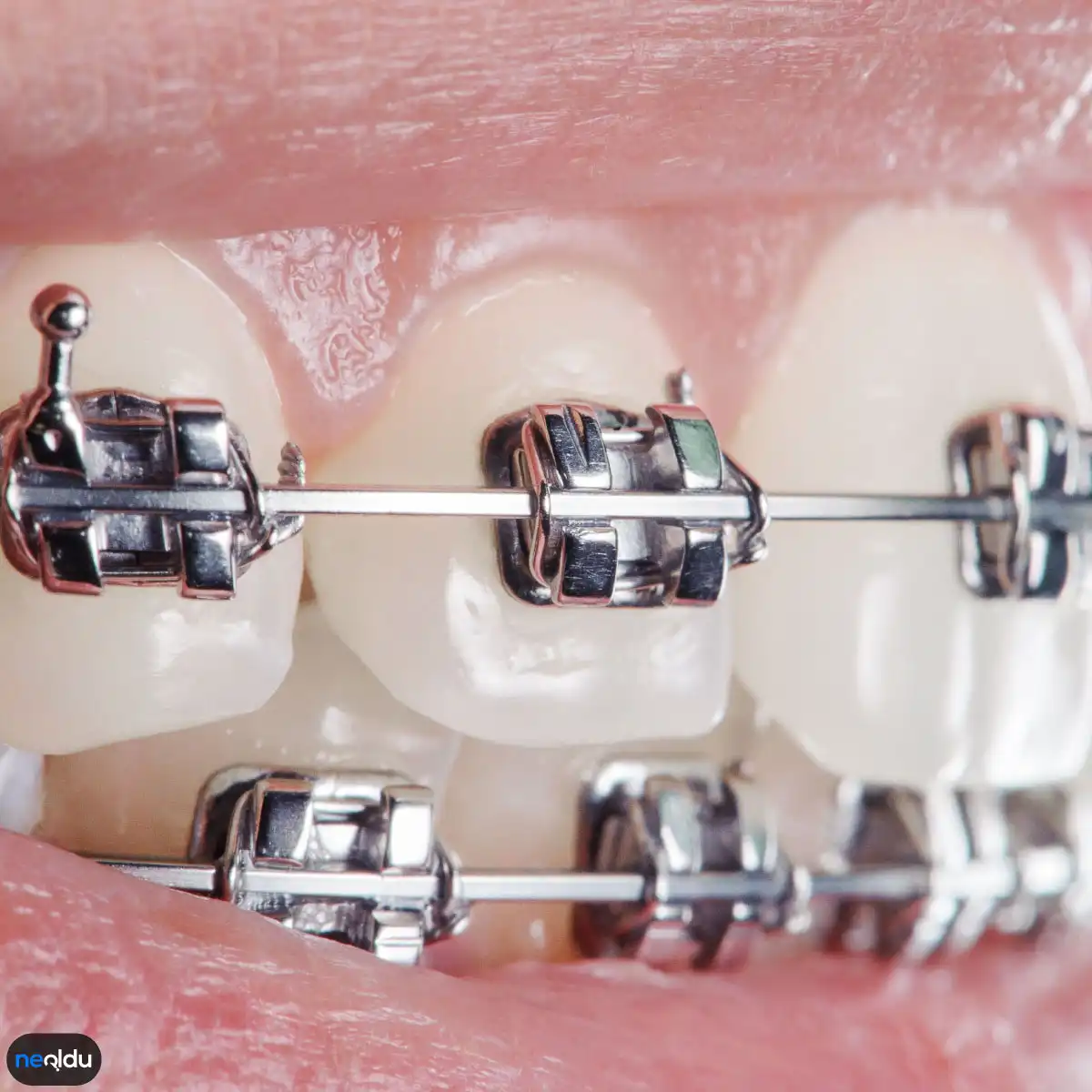 Diş Teli Takacak Kişilerin Mutlaka Bilmesi Gereken Bilgiler