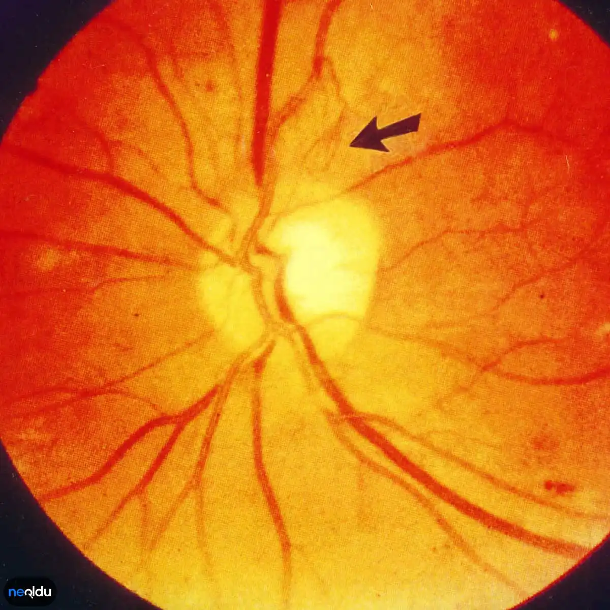 День сетчатки. Препролиферативная ретинопатия. Транзиторная диабетическая ретинопатия.