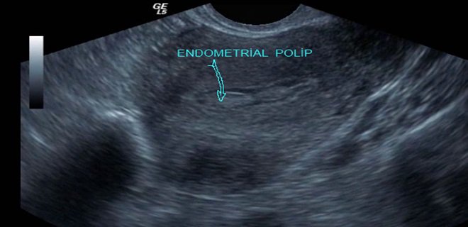 endometrial-polip-teshisi.jpg