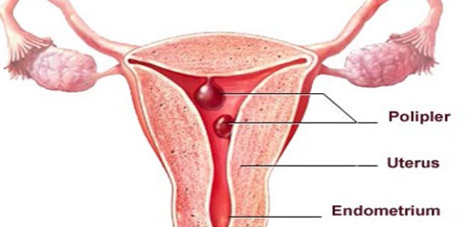 endometrial-polip.jpg