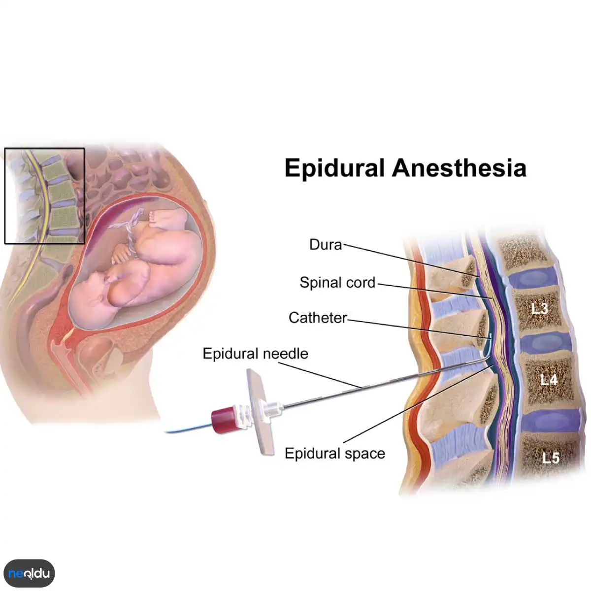 Epidural Anestezi