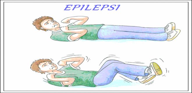 epilepsi-nobetleri-002.gif