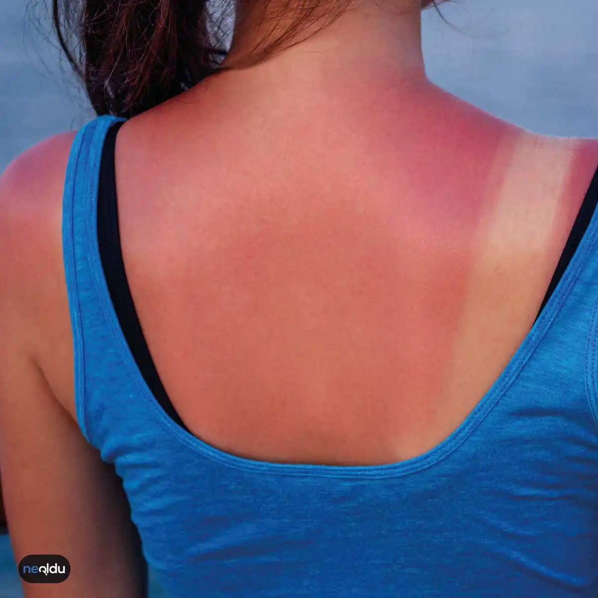 Güneşin Cilde Etkisi ve Korunmamız Gereken UV Işınları