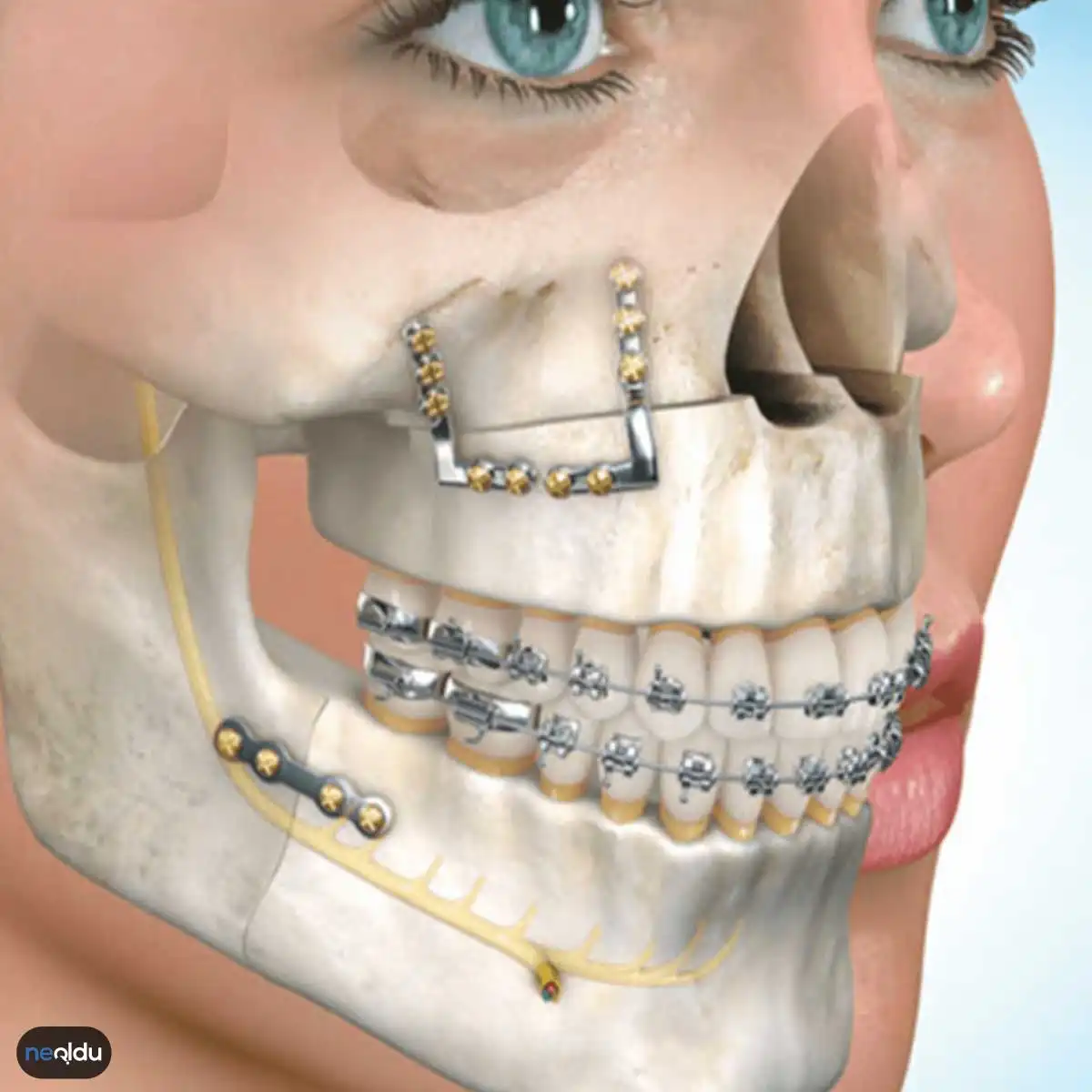 Hareketli Ortodontik Tedavi