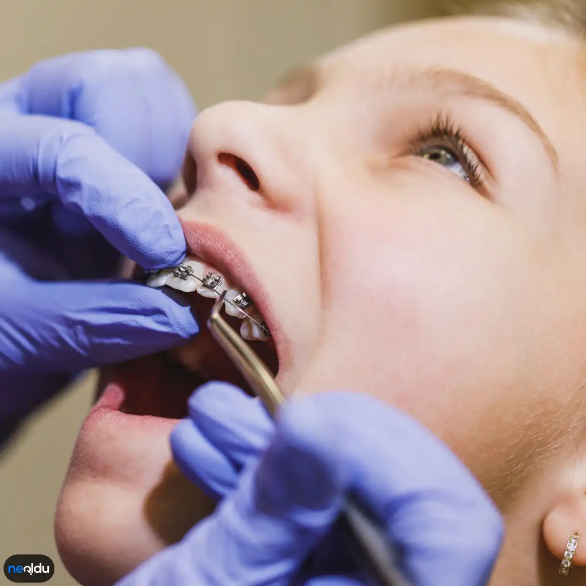 Koruyucu ve Önleyici Ortodonti Tedavi Nedir, Neler Yapılır?