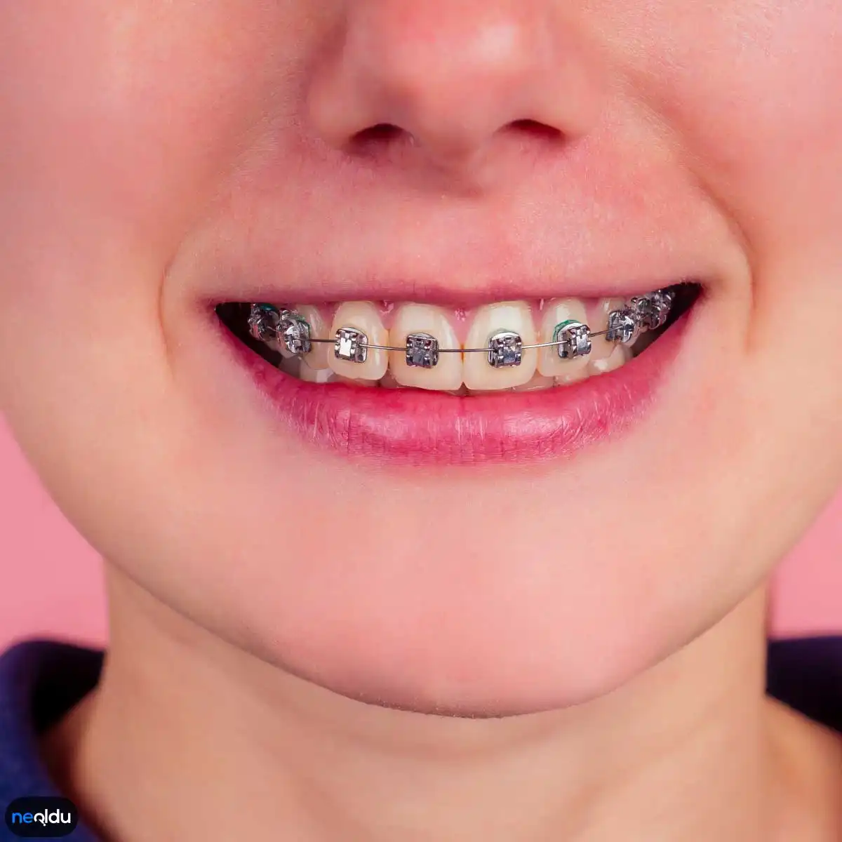 Koruyucu ve Önleyici Ortodonti Tedavi Nedir, Neler Yapılır?