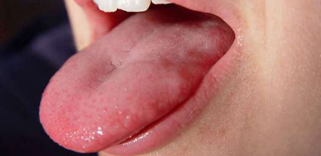 What Is Leukoplakia Symptoms And Treatment Methods İ