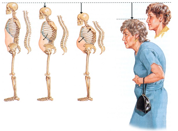 osteoporoz-nedenleri.jpg