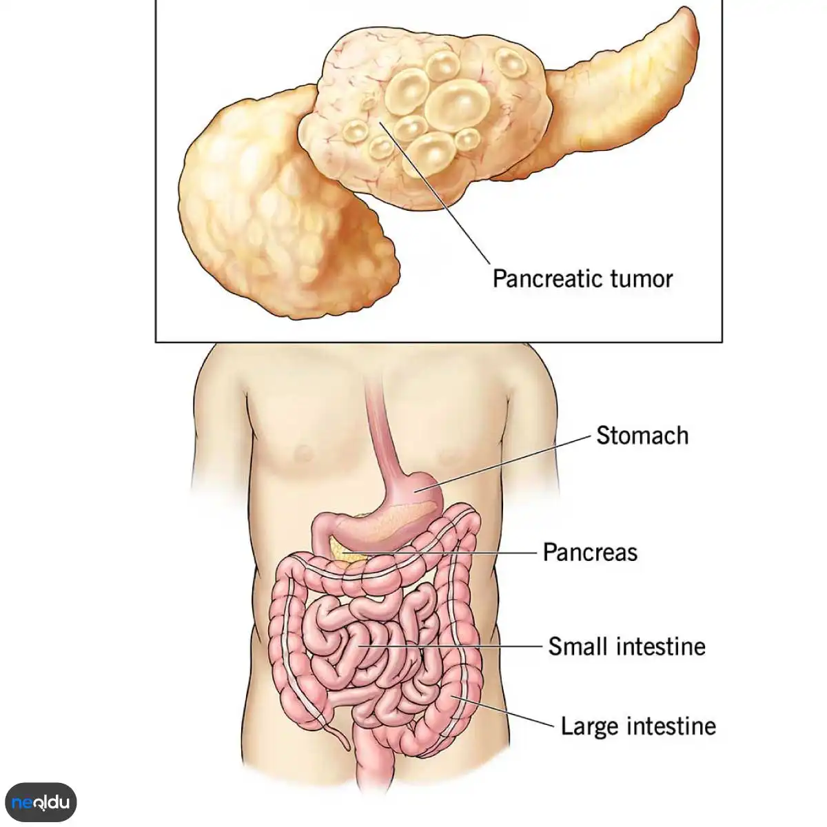 pankreas kanseri