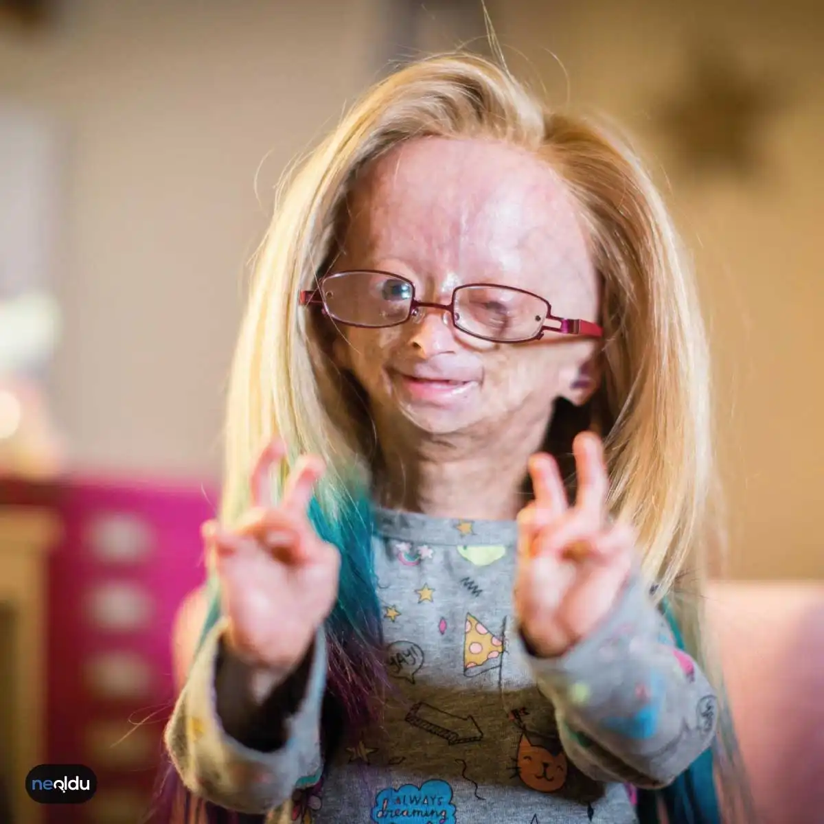 Progeria