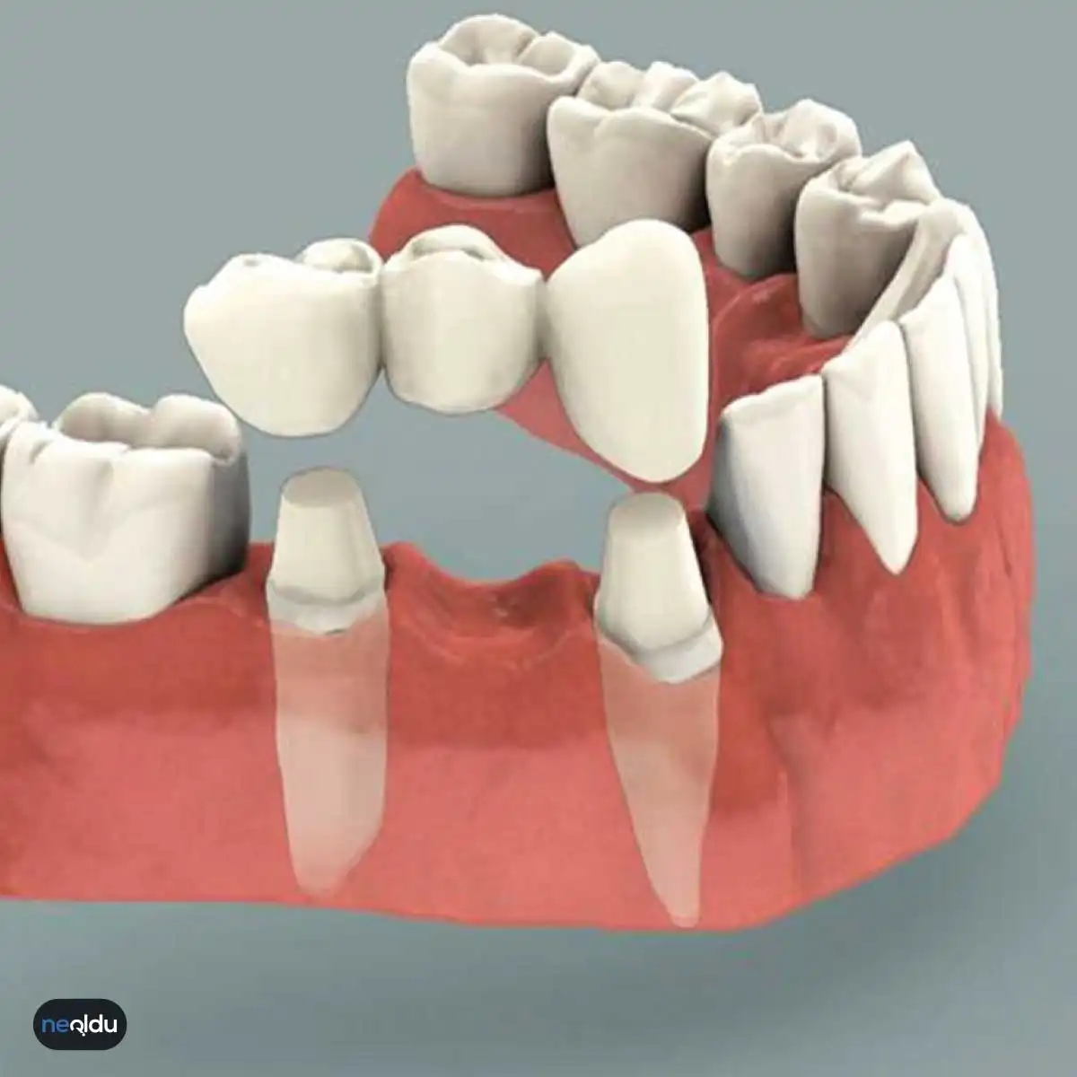 Protetik Diş Tedavisi Nedir, Çeşitlieri Nelerdir? Bakımı