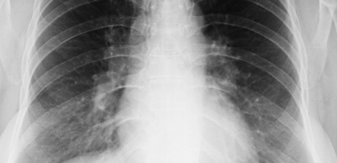 pulmoner-hipertansiyonlu-bir-hastanin-akciger-grafisi.JPG