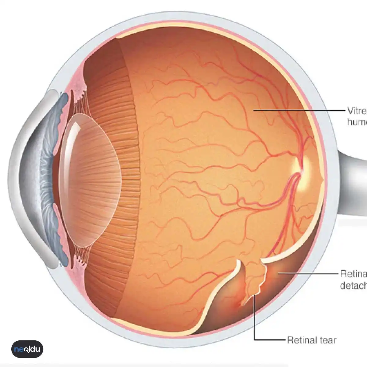 Внутренняя сетчатка. Сетчатая оболочка глаза ретина. Макула и фовеа. Клапанный разрыв сетчатки.