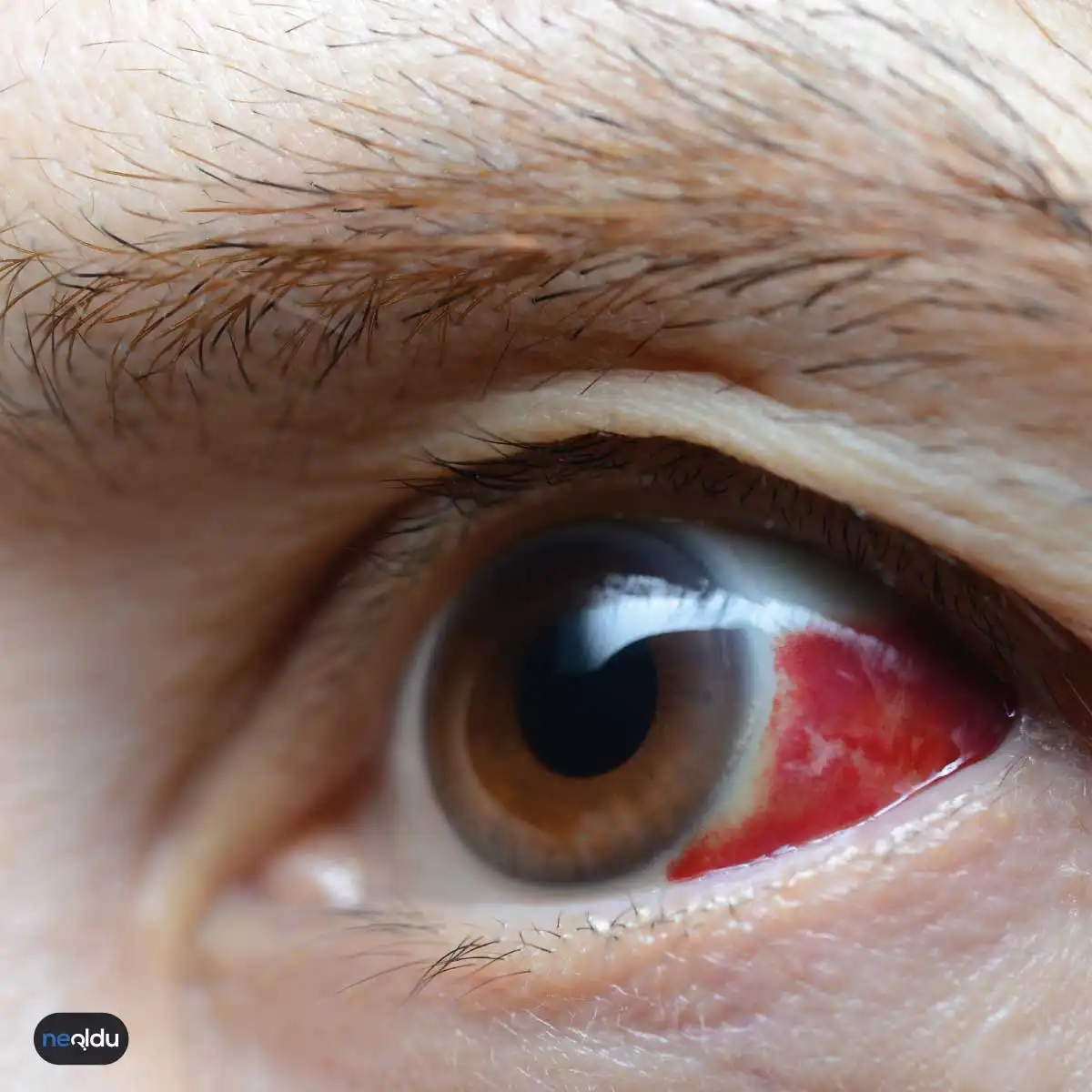 yaşlılarda görülen göz hastalıkları
