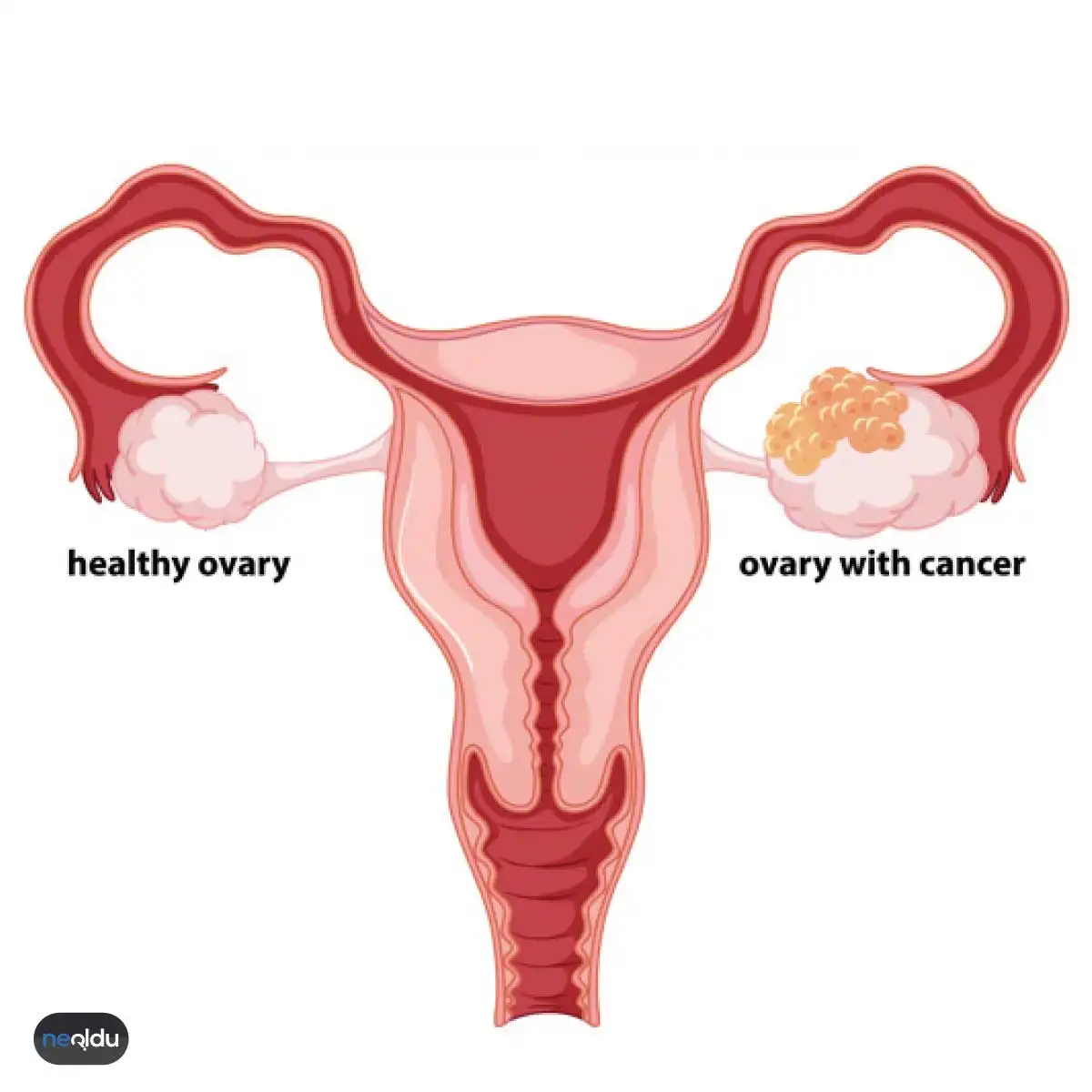 Рак яичников причины. Злокачественные новообразования яичников. Онкология яичников у женщин.